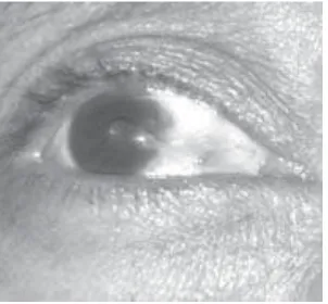 FIGURE 3. Pterygium recurrence in triamcinolon acetonidegroup after 3 month follow up.