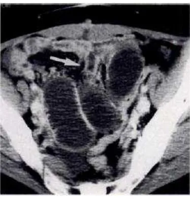 Gambar 7. CT-scan menunjukkan adanya dilatasi jejunum dengan transisi yang jelas, bagian distal kolaps