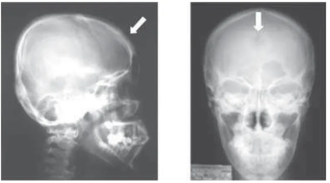 FIGURE 1.Skull X ray revealed a punch out lesion in frontal bone, pointed by white arrows