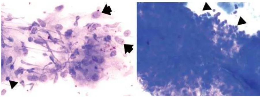 FIGURE 12. Smear obtained from FNAB showed clustered and dispersed cells, composed of ephitheloid cells (arrows) admixedwith inflammatory cell, particularly lymphocytes (arrow heads)  (Giemsa staining, 100 X)