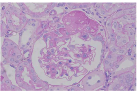 Gambar 1. Gambaran glomerulus pada nefropati diabetik 10   