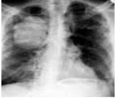 Gambar 2.1. Gambar chest X-RAY dari kanker paru-paru  (Adzani,2019) 