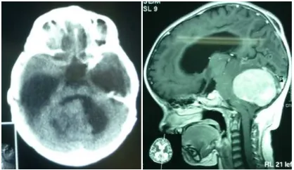 Gambar 1 Head CT-scan terlihat massa tumor komponen solid-kistik pada fossa posterior menekan pons dengan pelebaran ventrikel IV