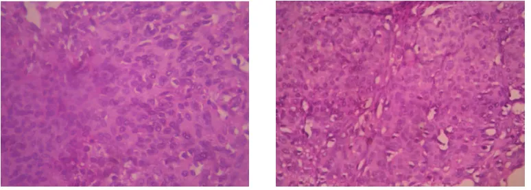 Gambar 4. Meningothelial meningioma, grade i who. sel-sel tumor dengan ini bulat, oval, sebagian dengan kromain halus sedangkan sisanya dengan kromain kasar, dijumpai clearing (penjernihan ini), dan struktur whorl kecil yang dipisahkan jaringan ikat.