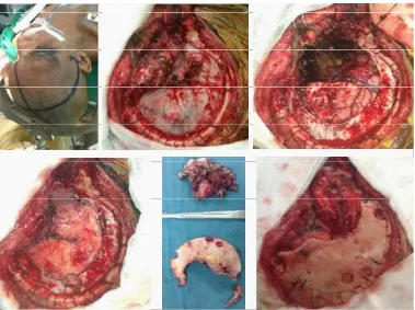 Gambar 9. head cT-scan kontrol 7 hari post operasi masih terlihat sisa massa tumor hiperdens 