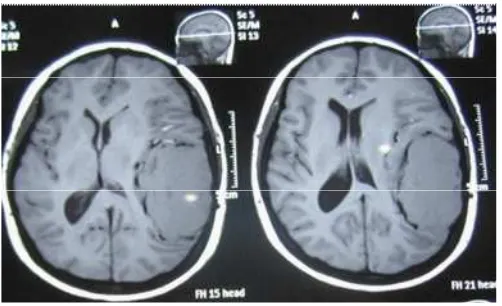 Gambar 2. MRI kepala T1 kontras potongan sagital (A), koronal (B), dan aksial (c) serta T2 aksial (D) terlihat massa hiperintens yang cukup besar dengan perifokal edema minimal pada daerah temporoparietalis kiri dengan gambaran dural tail