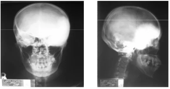 Gambar 14. cT scan kepala potongan koronal dan sagital memperlihatkan lesi hiperdens batas tegas pada daerah sfenotemporalis dengan penebalan disertai gambaran gound-glass os sfenofrontotemporalis kiri dan massa jaringan lunak sekitar.