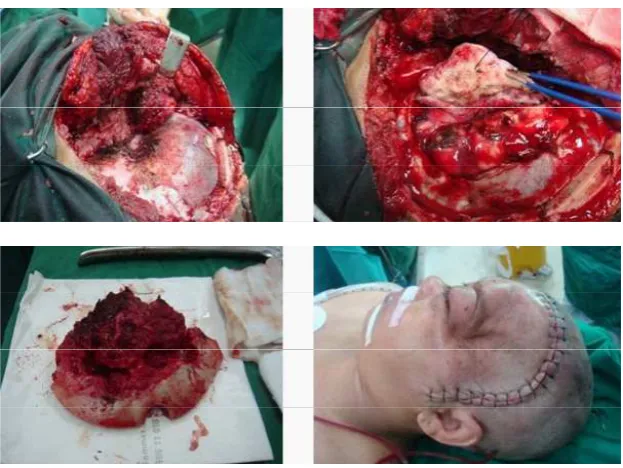 Gambar 15. durante operasi