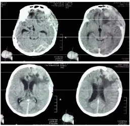 Gambar 21. Meningothelial meningioma, tampak struktur lobulus yang dipisahkan oleh jaringan ikat (hE, 100X)