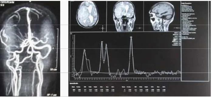 Gambar 23. MRI brain laki-laki 71 tahun potongan aksial, koronal, sagital terlihat massa ekstraaksial, batas tegas, hipointens T1, slight hiperintens pada T2 dan FlAIR serta menyangat kuat (hiperintens) pasca kontras dengan perifokal edema di daerah tempor