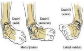 Gambar 2. Sprain 
