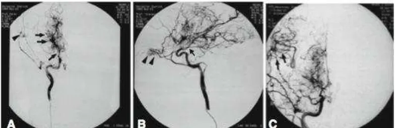 Gambar 2. Anak perempuan berumur 9 tahun dengan TIA. DSA dengan posisi AP menunjukkan stenosis caroid fork (tanda panah) dengan vaskulatur yang abnormal pada basal ganglia (dua tanda panah)