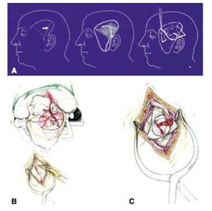 Gambar 3. Kulit ditandai sesuai aliran STA cabang frontal dan parietal (kiri). STA terlihat setelah diseksi (kanan)