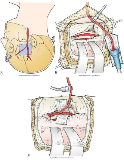Gambar 7. Bypass STA-SCA. (A) Insisi dan craniotomy. (B). Exposure STA melalui subtemporal approach dan pengukuran aliran STA melalui ultrasonic flow probe