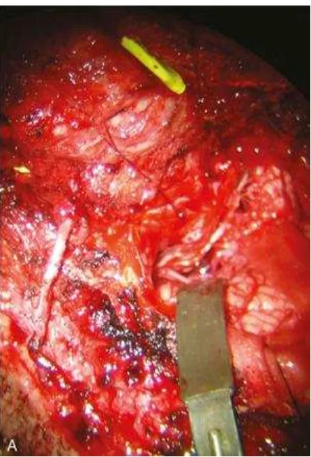 Gambar 10. Anastomosis OA-PICA. A-C. Pedicle graft (sisi kanan). Ddan E. Arterial interposition graft