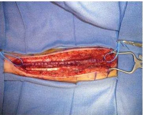 Gambar 12. Graft arteri radialis. Dikutip dari Sweeney JM, (editor). Cerebral Revascularization