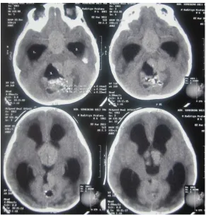 Gambar 2. Lesi hiperdense pada daerah sisterna basalis sampai ventrikel 3 dan  ventrikel 4 dengan kalsifikasi pada ventrikel 4 disertai hydrocephalus