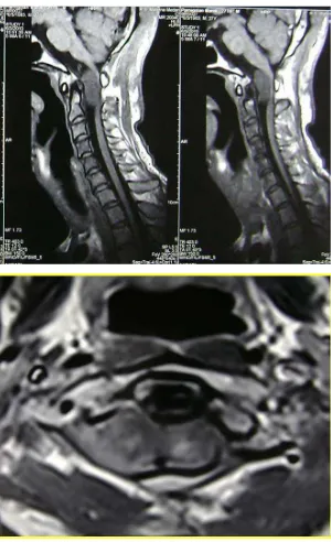 Gambar 3. Tampak lesi hiperdens pada CPA kiri yang menekan hemisfer serebellum dan CPA  dengan defek pada os occipitalis kiri