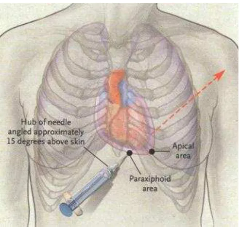 Gambar 5   Teknik Perikardiosintesis 