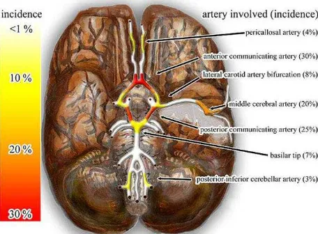 Gambar 1. Lokasi-lokasi dari Saccular aneurysma.  Dikutip dari : Wikipedia, the free encyclopedia