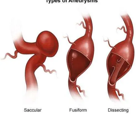 Gambar 2. Jenis-jenis aneurysma. Dikutip dari: Johns Hopkins Medicine. Heath Library. Available at : http://www.hopkinsmedicine.org/healthlibrary/conditions/cardiovascular_diseases/cerebral_aneurysm_85,P08772/ on 27/08/2012 