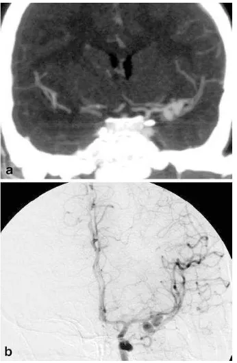 Gambar 11.   Ventricular Mass pada Partial-Thrombosed Thrombosed basilar apex aneurysm presenting as a third ventricular Aneurysm