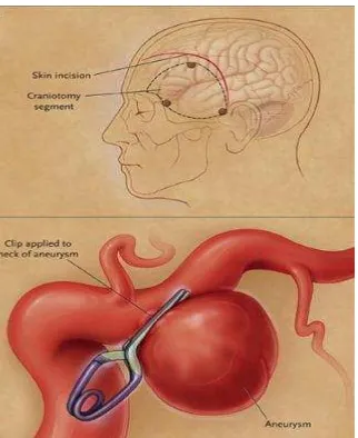 Gambar 12.  Metode Clipping Pada Aneurisma intrakranial. Dikutip dari : Lee KC, Lee KS, Shin YS, LeeJW, Chung SK