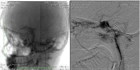 Gambar 7.  Tipikal dari  carotid-cavernous fistula. Proyeksi lateral dari substraction angiografi menunjukkan pengisian dari arteri karotis interna dengan sinus kavernosus sebagai akibat robeknya arteri karotis interna intrakavernosus