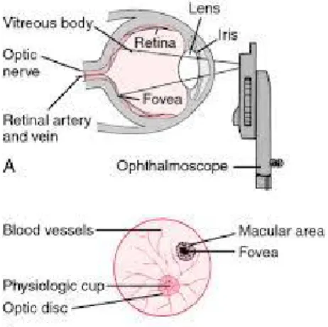 Gambar 2. Ilustrasi penafsiran pemeriksaan oftalmoskopi