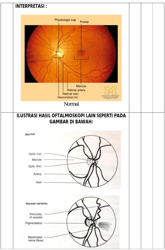 ILUSTRASI HASIL OFTALMOSKOPI LAIN SEPERTI PADA GAMBAR DI BAWAH: