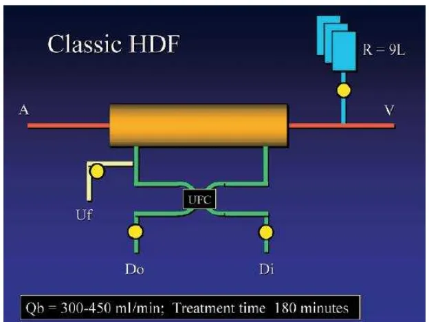 Gambar 10. Evolusis dari hemodiafiltrasi. Classic HDF menggunakan sekitar 9 liter cairan subsitusi