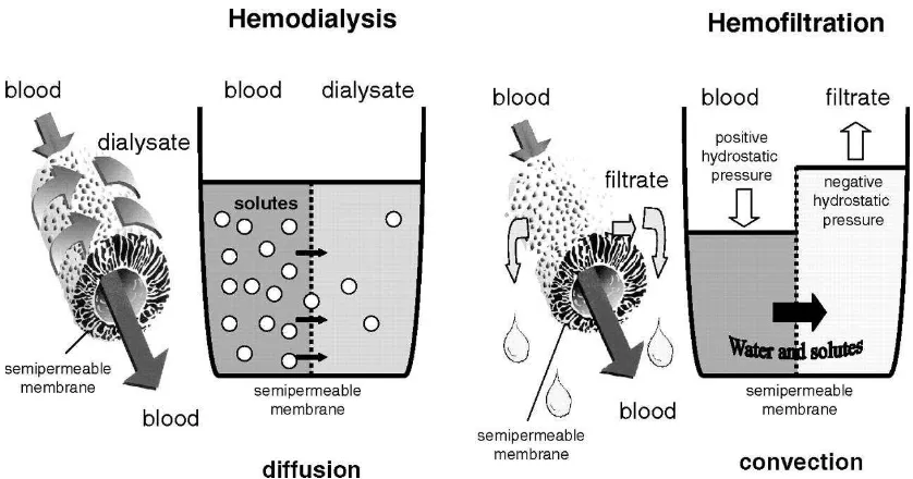 Gambar 4. Perbedaan mekanism penyaringan pada hemodialisis dan hemofiltrasi. Pada hemodialisis terjadi perpindahan molekul secara difusi