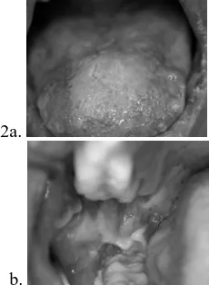 Gambar 1. Gambaran mukosa oral yang erosi, dangkal, sebagian tertutup lapisan putih kekuningan tebal yang dapat diangkat dengan meninggalkan dasar eritema dan sebagian tidak dapat diangkat