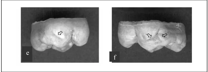 Gambar 4. (e) Tonjol carabelli tipe III dilihat dari palatal (satu groove),              (f) Tonjol carabelli tipe III dilihat dari palatal (dua groove)13 