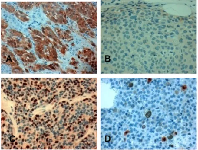 Gambar 1. Pewarnaan P16 dan Ki67 pada melanoma  nodular.  (a).  Pulasan  p16  dengan  Overekspresi  p16  pada  inti  dan  sitoplasma  (index  pewarnaan  2-9)