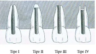 Gambar 1. Berbagai bentuk penutupan apeks setelah perawatan apeksifikasi (diambil dari: Weine FS