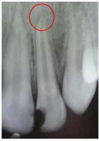 Gambar 2. Hasil radiografi periapikal yang diambil 15 Mei 2010, tampak ujung akar gigi 22  yang belum menutup sem-purna