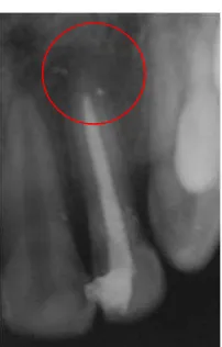 Gambar 3. Pada ronsen foto tampak pasta kalsium hidroksid yang mengisi saluran akar  pada gigi 22 yang ujung akarnya belum menutup sempurna