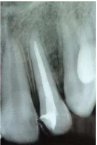 Gambar 6. Radiograf gigi 22 1 minggu pasca pengisian saluran akar/ obturasi. Tampak  radiolusen pada saluran akar sampai ke ujung akar
