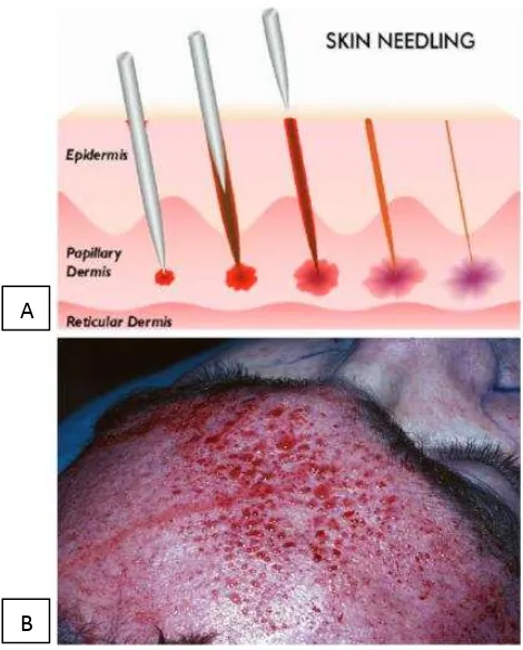 Gambar 5. (A) skema prosedur skin needling, (B) gambaran intra operatif prosedur skin 