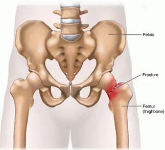 Gambar 1.1 Hip fracture (Carter, 2007) 