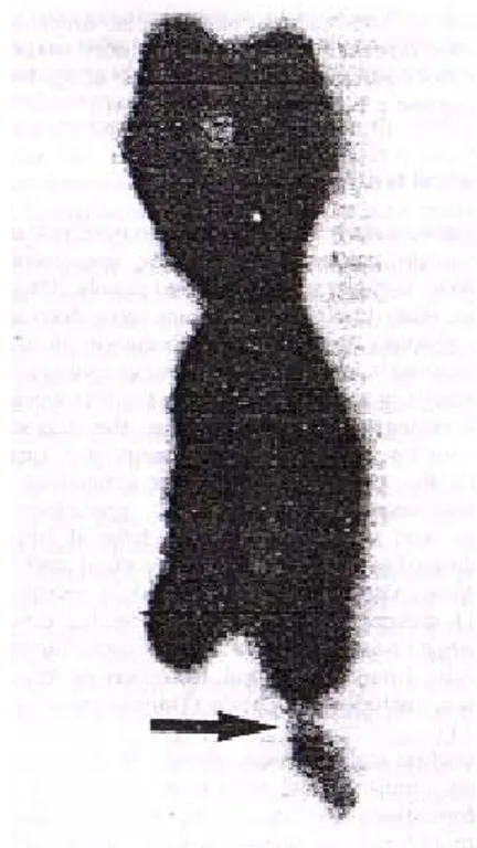 Gambar 1. Kromosom Fragile X  Dikutip dari Fenichel,1997