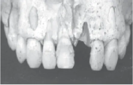 Gambar 2.Pangur gigi-geligi dengan pencabutankedua gigi seri dan taring kiri dan kanan padarahang atas sampel Caruban (Jawa Tengah)