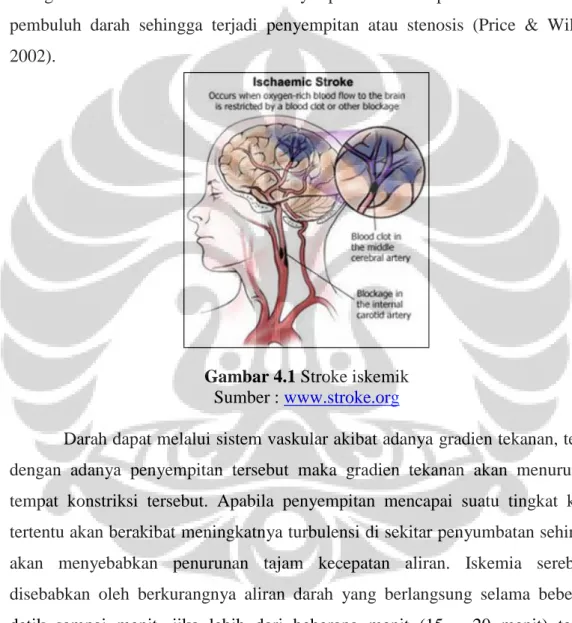 Gambar 4.1 Stroke iskemik  Sumber : www.stroke.org 