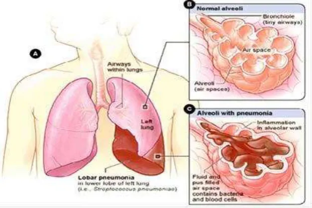 Gambar 1. Patofisologi Pneumonia 