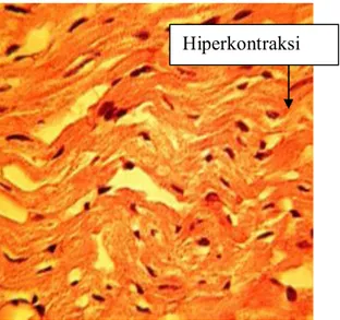 Gambar 4. Gambaran hiperkontraksi serabut otot  jantung tikus wistar yang terpapar arus  listrik bolak balik (alternating current) 91-120 mA secara langsung  dengan mikroskop 