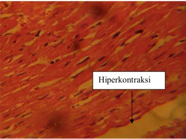 Gambar 5. Gambaran hiperkontraksi serabut otot  jantung tikus wistar yang terpapar arus  listrik bolak balik (alternating current)1-30 mA melalui medium air  dengan mikroskop 