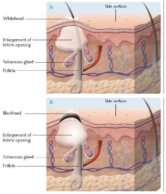 Gambar 2.3 Komedo tertututp (3a) dan komedo terbuka (3b) (Lavers, 2014) 