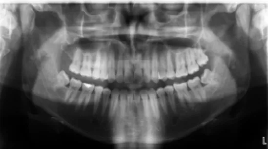 Gambar 2.8 Radiografi periapikal yang memperlihatkan foramen mentale (tanda panah) radiolusen  berbentuk oval dekat dengan apeks premolar kedua (sumber : White SC