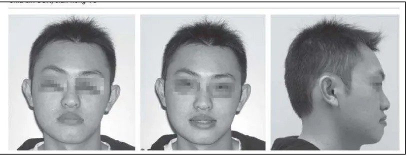 Gambar 1. Asimetri wajah pada pasien gigitan terbalik anterior maloklusi Klas III  14 